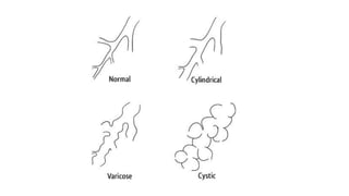 Bronchiectasis, condition of lower respiratory tract | PDF