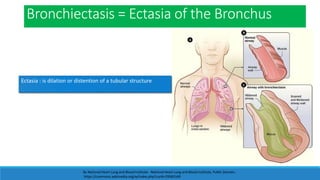 Bronchiectasis = Ectasia of the Bronchus
By National Heart Lung and Blood Institute - National Heart Lung and Blood Institute, Public Domain,
https://commons.wikimedia.org/w/index.php?curid=29583169
Ectasia : is dilation or distention of a tubular structure
 