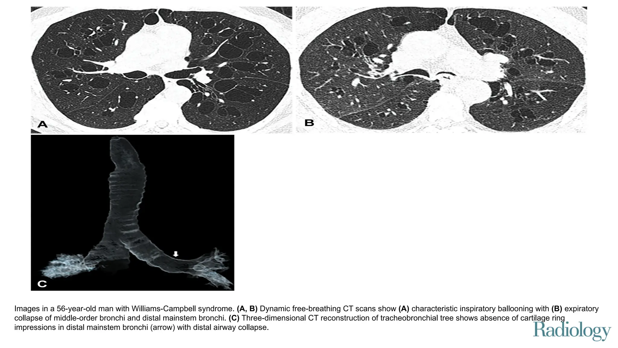 Images in a 56-year-old man with Williams-Campbell syndrome. (A, B) Dynamic free-breathing CT scans show (A) characteristic inspiratory ballooning with (B) expiratory
collapse of middle-order bronchi and distal mainstem bronchi. (C) Three-dimensional CT reconstruction of tracheobronchial tree shows absence of cartilage ring
impressions in distal mainstem bronchi (arrow) with distal airway collapse.
 