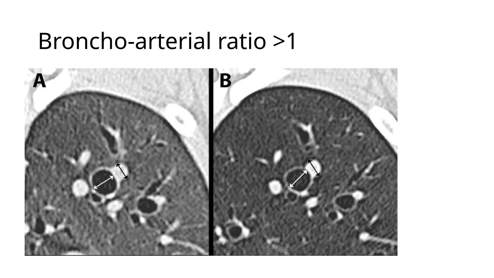 Broncho-arterial ratio >1
 