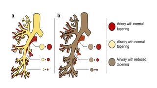 Bronchiectasis Guidelines from the British Thoracic Society | PPTX