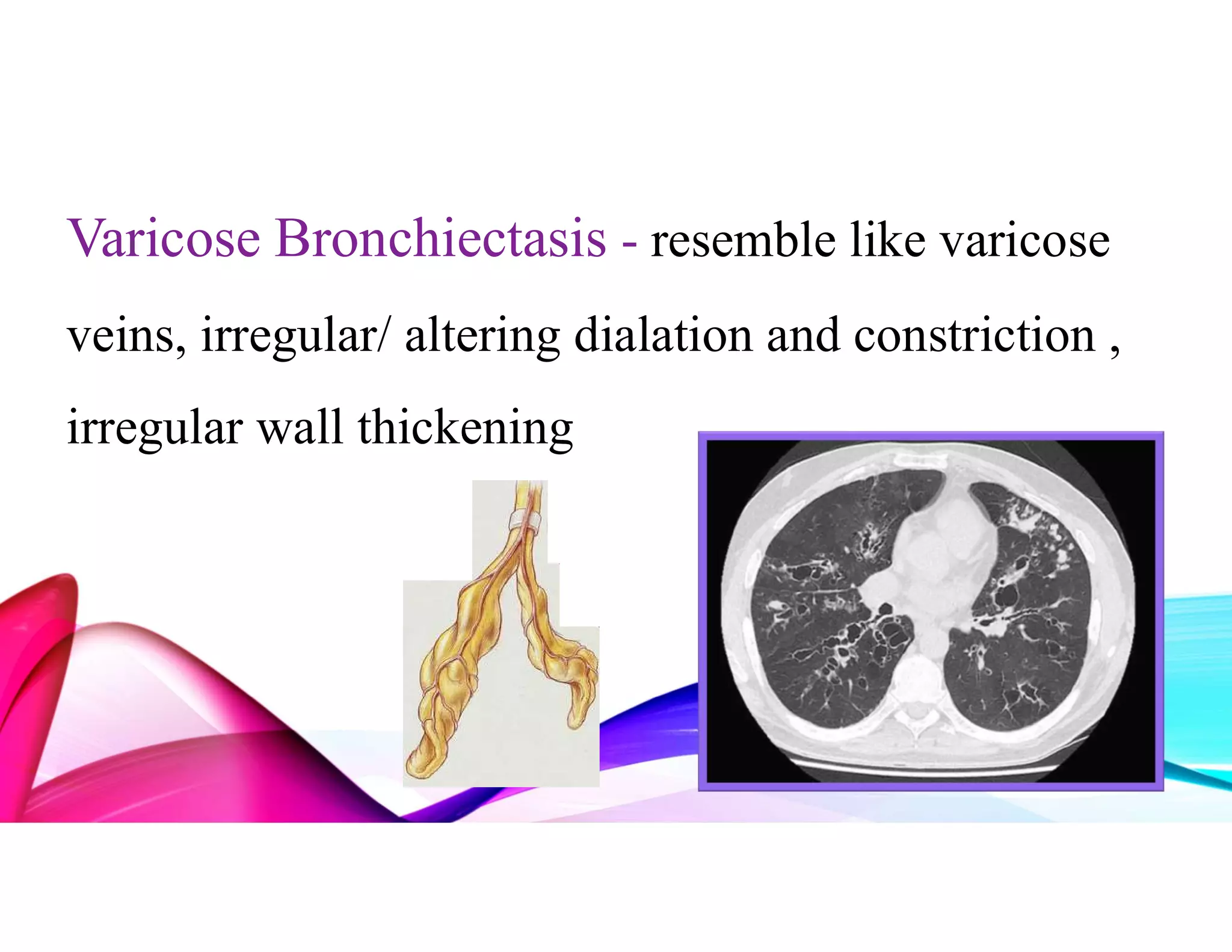 BRONCHIECTASIS PPT .pdf