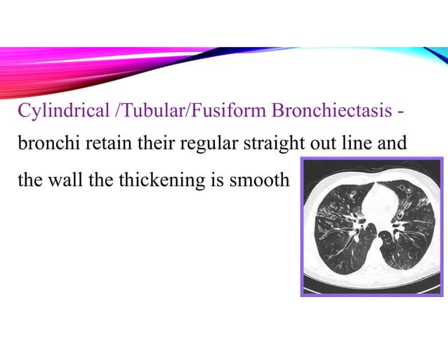 BRONCHIECTASIS PPT .pdf