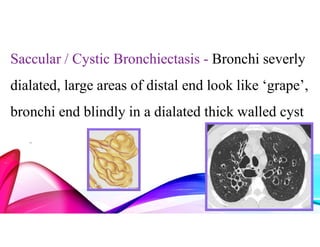 Saccular / Cystic Bronchiectasis - Bronchi severly
dialated, large areas of distal end look like ‘grape’,
bronchi end blindly in a dialated thick walled cyst
–
 