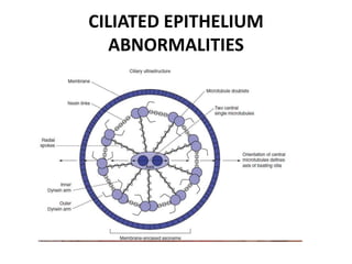 CILIATED EPITHELIUM
ABNORMALITIES
 
