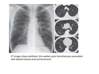 CT images show multifocal, thin-walled cystic bronchiectasis associated
with dilated trachea and central bronchi
 