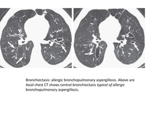 Bronchiectasis: allergic bronchopulmonary aspergillosis. Above are
Axial chest CT shows central bronchiectasis typical of allergic
bronchopulmonary aspergillosis.
 