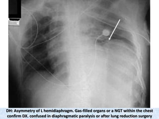 DH: Asymmetry of L hemidiaphragm. Gas-filled organs or a NGT within the chest
confirm DX. confused in diaphragmatic paralysis or after lung reduction surgery
 