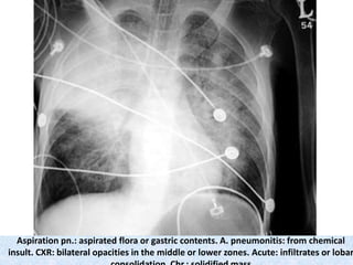 Aspiration pn.: aspirated flora or gastric contents. A. pneumonitis: from chemical
insult. CXR: bilateral opacities in the middle or lower zones. Acute: infiltrates or lobar
 