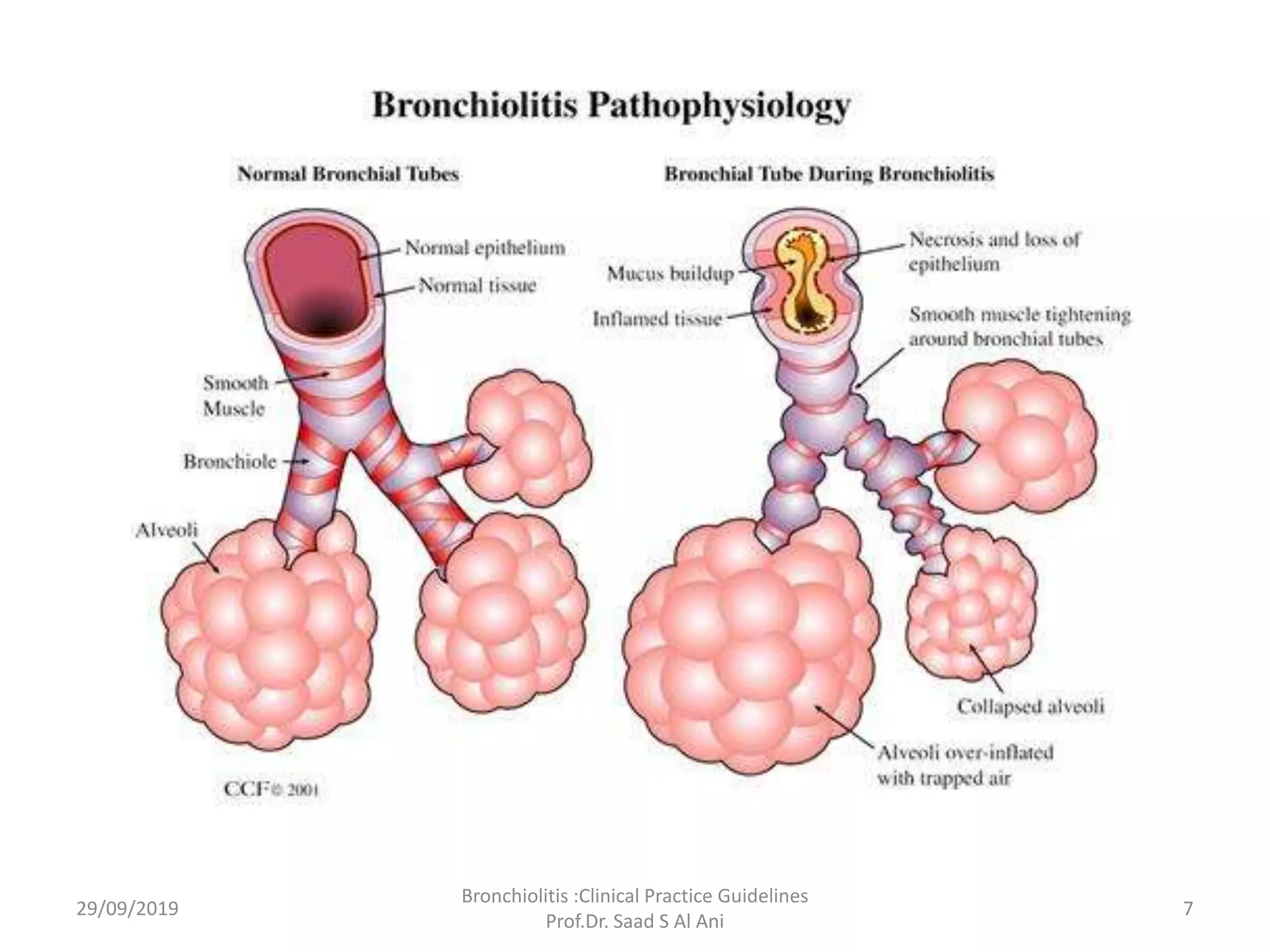 Bronchiolitis | PPTX