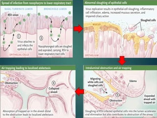 Bronchiolitis.pptx