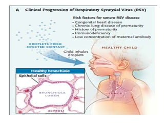 Broncholite Comprehensive Overview of Bronchiolitis in Infants: Causes, Symptoms ...