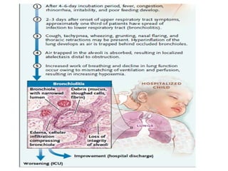 Comprehensive Overview of Bronchiolitis in Infants: Causes, Symptoms ...