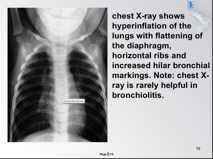 Bronchiolitis by Ng
