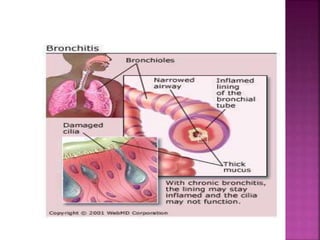 Bronchitis | PPTX
