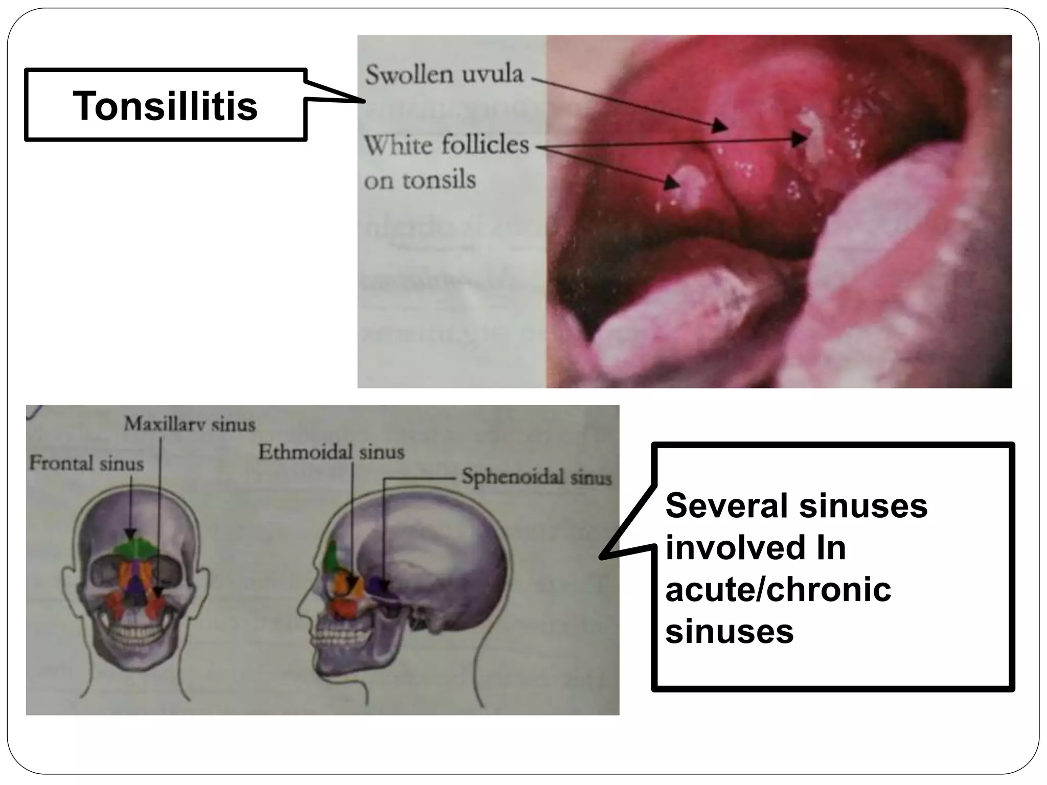 Tonsillitis
Several sinuses
involved In
acute/chronic
sinuses
 