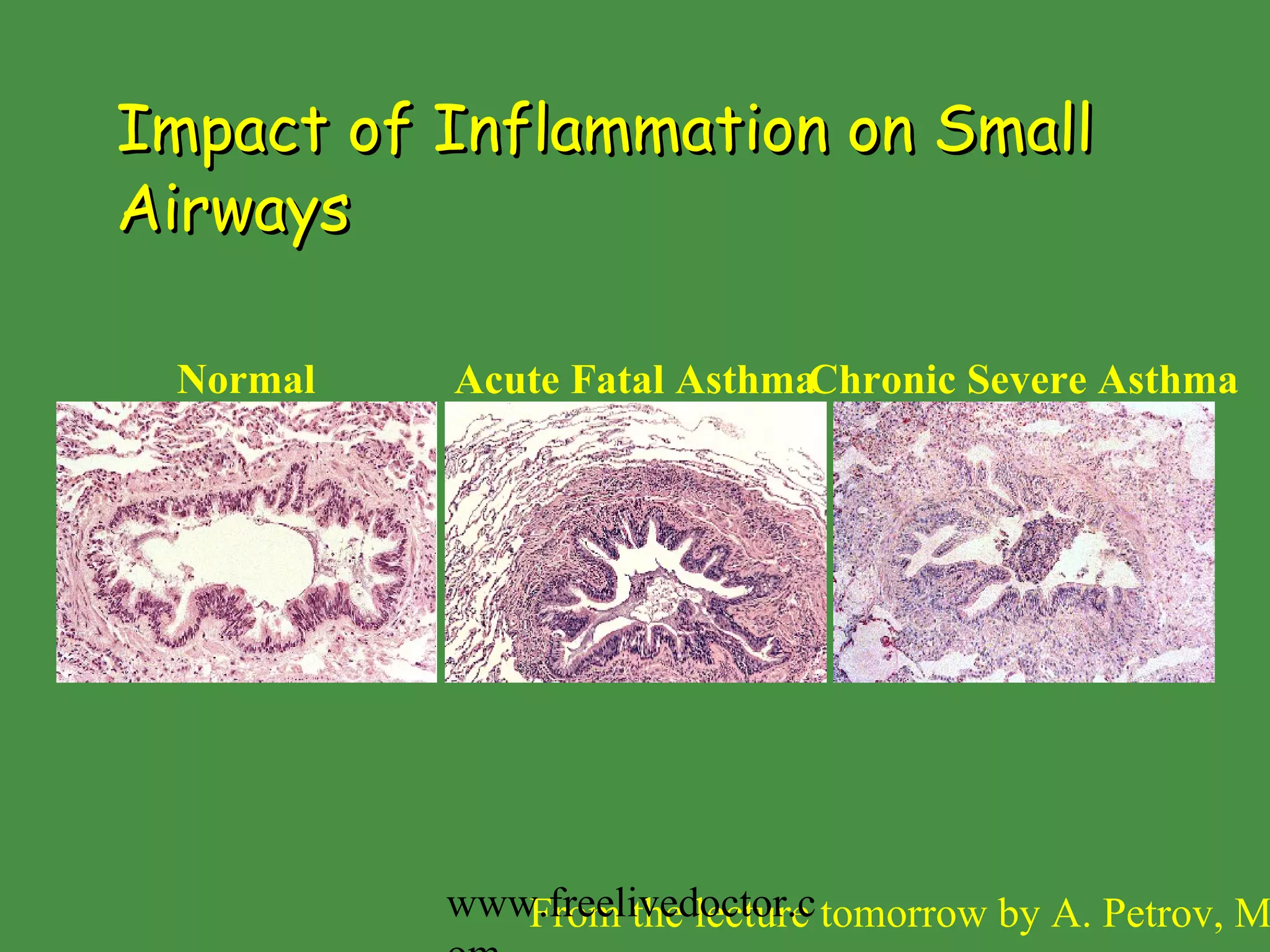 Impact of Inflammation on Small Airways Acute Fatal Asthma Normal Chronic Severe Asthma From the lecture tomorrow   by A. Petrov, MD www.freelivedoctor.com 
