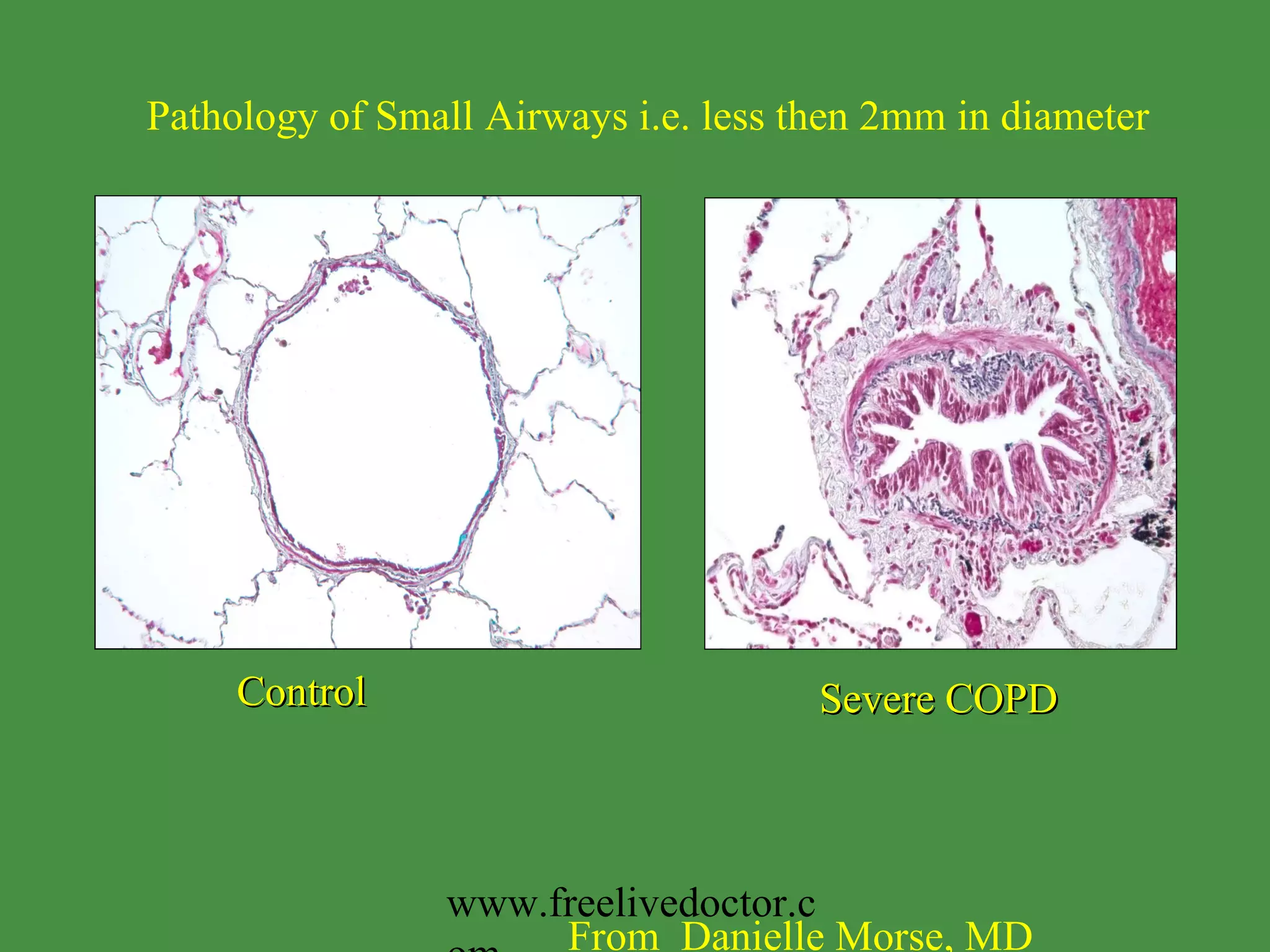 Control Severe COPD Pathology of Small Airways i.e. less then 2mm in diameter From  Danielle Morse, MD www.freelivedoctor.com 