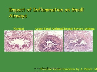 Impact of Inflammation on Small Airways Acute Fatal Asthma Normal Chronic Severe Asthma From the lecture tomorrow   by A. Petrov, MD www.freelivedoctor.com 