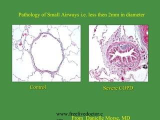 Control Severe COPD Pathology of Small Airways i.e. less then 2mm in diameter From  Danielle Morse, MD www.freelivedoctor.com 