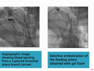 Angiographic image
showing blood ejecting
from a ruptured bronchial
artery branch (arrow)
Selective embolization of
the feeding artery
obtained with gel foam.
146
 