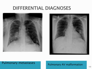 Pulmonary metastases
Pulmonary AV malformation
172
 