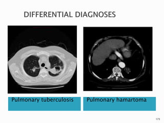 Pulmonary tuberculosis Pulmonary hamartoma
173
 