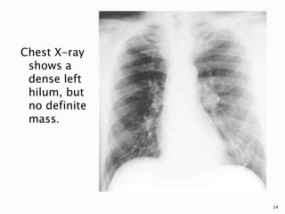 Chest X-ray
shows a
dense left
hilum, but
no definite
mass.
24
 