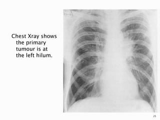 Chest Xray shows
the primary
tumour is at
the left hilum.
25
 