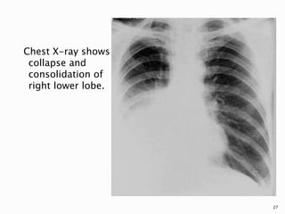 Chest X-ray shows
collapse and
consolidation of
right lower lobe.
27
 