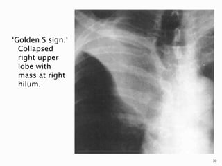 ‘Golden S sign.‘
Collapsed
right upper
lobe with
mass at right
hilum.
30
 