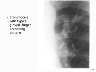  Bronchocele
with typical
gloved-finger
branching
pattern
32
 