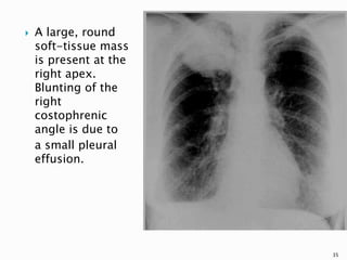  A large, round
soft-tissue mass
is present at the
right apex.
Blunting of the
right
costophrenic
angle is due to
a small pleural
effusion.
35
 