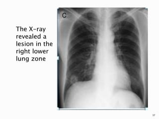 The X-ray
revealed a
lesion in the
right lower
lung zone
37
 
