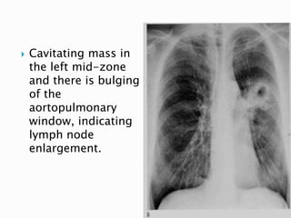  Cavitating mass in
the left mid-zone
and there is bulging
of the
aortopulmonary
window, indicating
lymph node
enlargement.
44
 