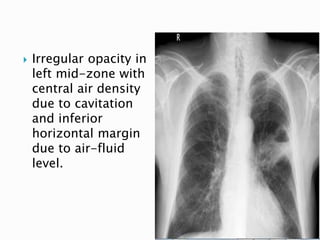  Irregular opacity in
left mid-zone with
central air density
due to cavitation
and inferior
horizontal margin
due to air-fluid
level.
45
 
