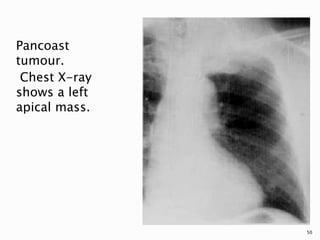 Pancoast
tumour.
Chest X-ray
shows a left
apical mass.
50
 