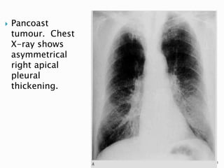  Pancoast
tumour. Chest
X-ray shows
asymmetrical
right apical
pleural
thickening.
51
 