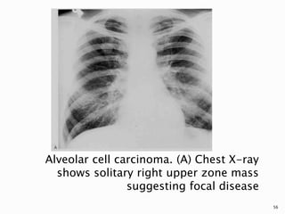 Alveolar cell carcinoma. (A) Chest X-ray
shows solitary right upper zone mass
suggesting focal disease
56
 