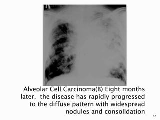 Alveolar Cell Carcinoma(B) Eight months
later, the disease has rapidly progressed
to the diffuse pattern with widespread
nodules and consolidation 57
 