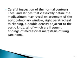  Careful inspection of the normal contours,
lines, and stripes that classically define the
mediastinum may reveal enlargement of the
aortopulmonary window, right paratracheal
thickening, a double density adjacent to the
aortic knob, all of which are frequent
findings of mediastinal metastasis of lung
carcinoma.
59
 