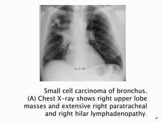 Small cell carcinoma of bronchus.
(A) Chest X-ray shows right upper lobe
masses and extensive right paratracheal
and right hilar lymphadenopathy.
60
 