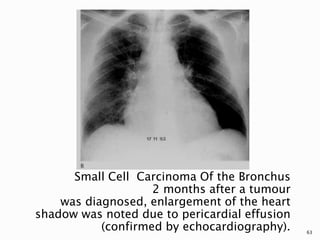 Small Cell Carcinoma Of the Bronchus
2 months after a tumour
was diagnosed, enlargement of the heart
shadow was noted due to pericardial effusion
(confirmed by echocardiography). 63
 