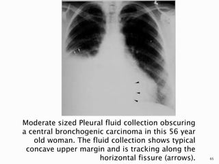 Moderate sized Pleural fluid collection obscuring
a central bronchogenic carcinoma in this 56 year
old woman. The fluid collection shows typical
concave upper margin and is tracking along the
horizontal fissure (arrows). 65
 