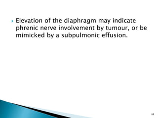  Elevation of the diaphragm may indicate
phrenic nerve involvement by tumour, or be
mimicked by a subpulmonic effusion.
68
 