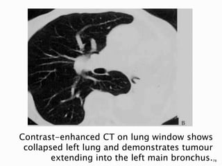 Contrast-enhanced CT on lung window shows
collapsed left lung and demonstrates tumour
extending into the left main bronchus.78
 