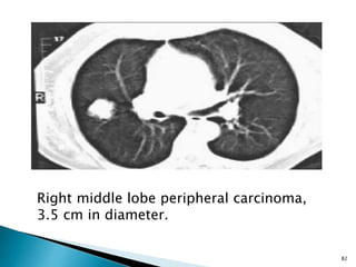 82
Right middle lobe peripheral carcinoma,
3.5 cm in diameter.
 