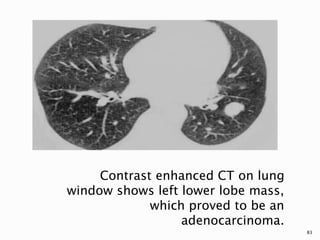 Contrast enhanced CT on lung
window shows left lower lobe mass,
which proved to be an
adenocarcinoma.
83
 