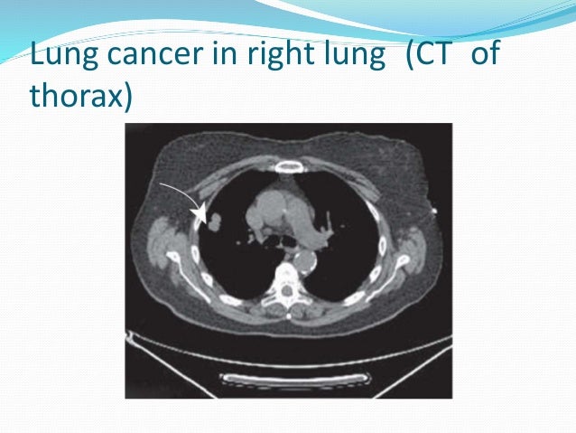 Bronchogenic carcinoma