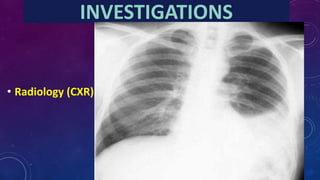 INVESTIGATIONS
• Radiology (CXR)
 